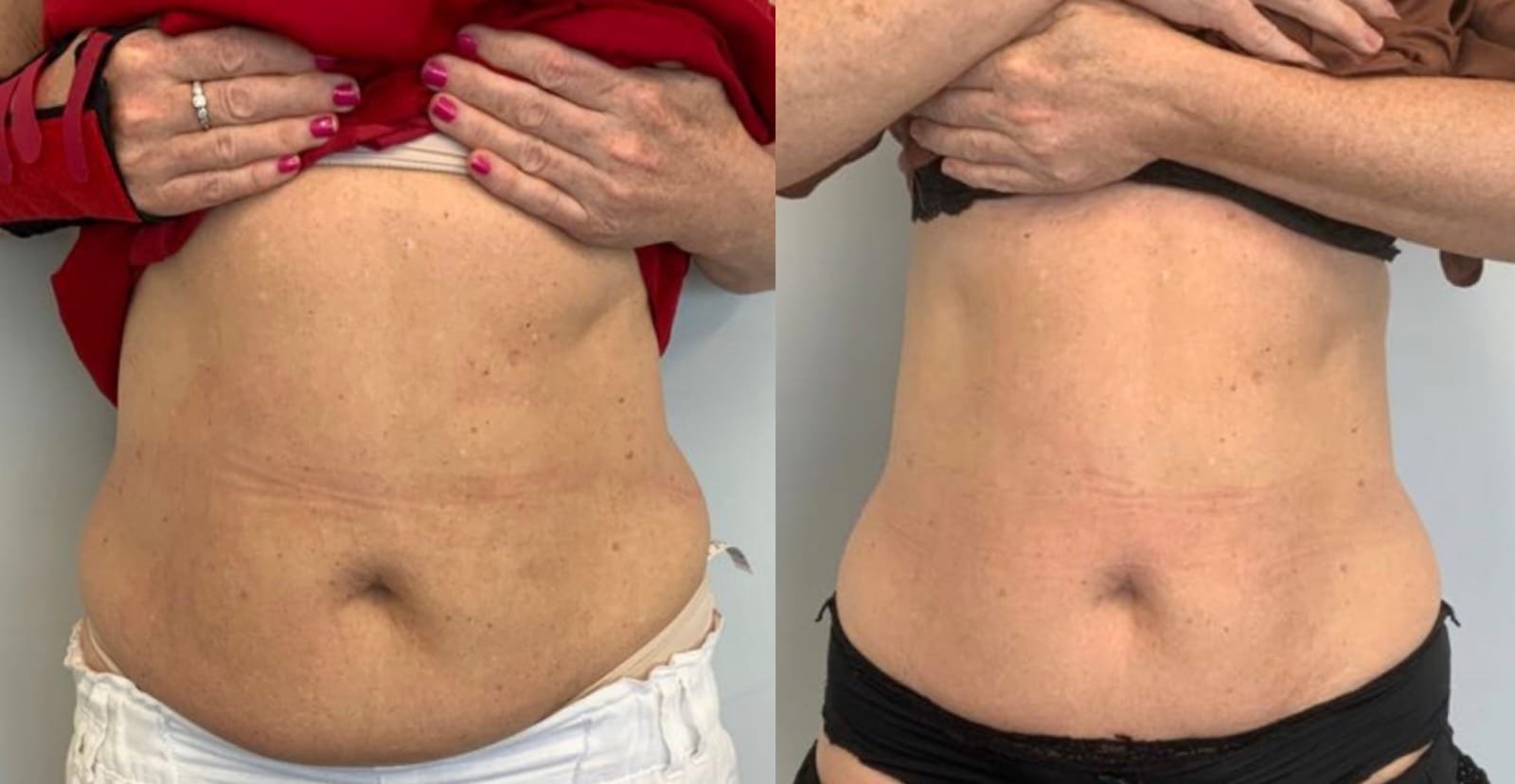 The Best Body-Contouring Procedures with Fast Results 1